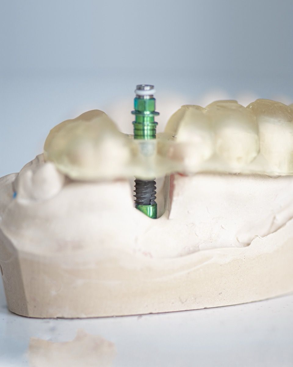 Model gipsowy łuku zębowego z nałożonym przezroczystym szablonem implantologicznym. Przez otwór w szablonie przechodzi implant na uchwycie